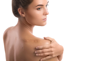 Woman with scar on her back